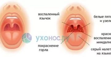 Горло не болит, но есть температура