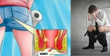 Боль в заднем проходе после ПА