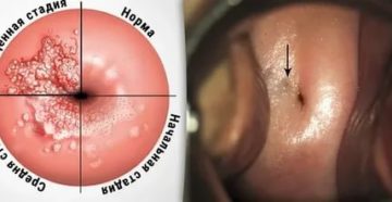 Прижигать ли эрозию перед второй беременностью?