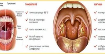 Налёт на гландах без температуры и боли Налёт на гландах без температуры и боли