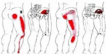 Чувство распирания в бедре Чувство распирания в бедре