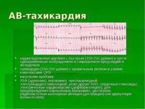 Наджелудочковые аритмии