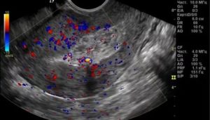 Кровотечение после узи