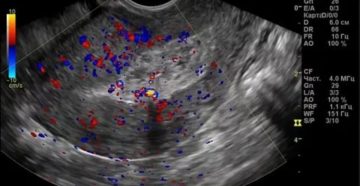 Кровотечение после узи