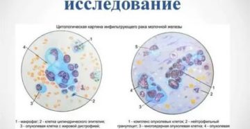 Помогите Расшифровать цитологическое исследования молочной железы