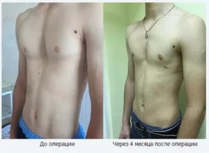 Вмятина на груди
