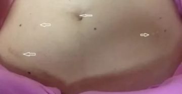 Месячные после лапароскопии, зуд