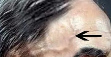 Вздутие вен на голове и пульсация Вздутие вен на голове и пульсация