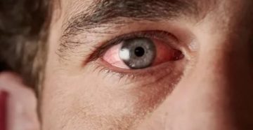 Покраснел один глаз