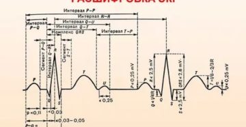 ЭКГ сердца расшифровка