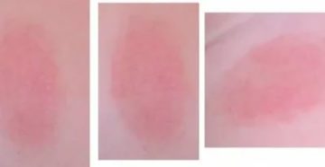 Пятно после укола Пятно после укола