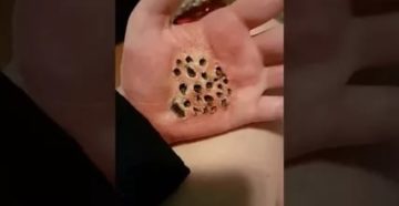 Странная ямка на коже