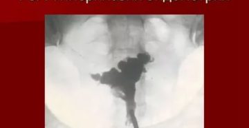 Кровотечение и гиперплазия эндометрии