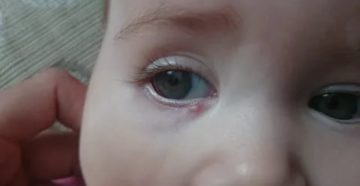 Появился прыщик в глазу у ребенка