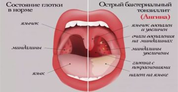 Боль гланды справа