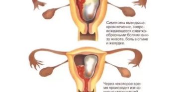 Выкидыш на 3-4недели очень болит живот и поясница