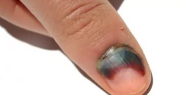 Раны под ногтями Раны под ногтями