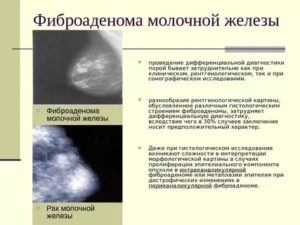 Фиброаденома или рак