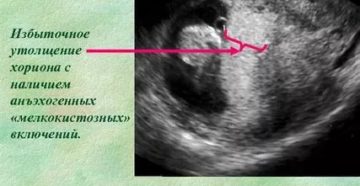 Диффузное утолщение хориона