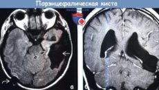 Порэнцефалическая киста головного мозга 4,4x3,9 см