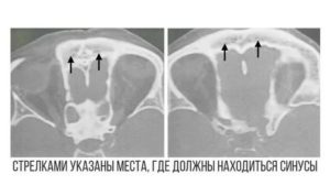 НЕдоразвитие правой лобной пазухи