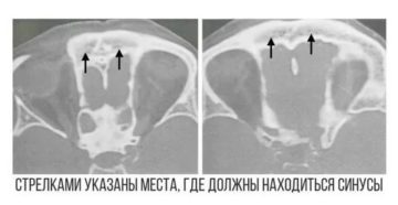 НЕдоразвитие правой лобной пазухи НЕдоразвитие правой лобной пазухи