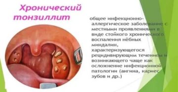 Фарингит и отит Фарингит и отит