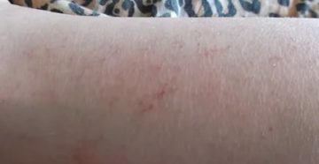 Непонятная сыпь под кожей Непонятная сыпь под кожей