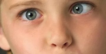 Косит глаз при напряжении зрения