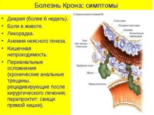 Болезнь крона у ребёнка