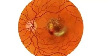 Дистрофия сетчатки при беременности