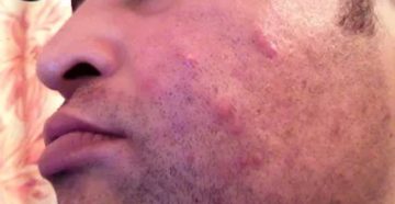 Гнойные прыщи после приёма Цикловиты
