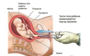 Беременность после хирургического аборта спустя 3 месяца