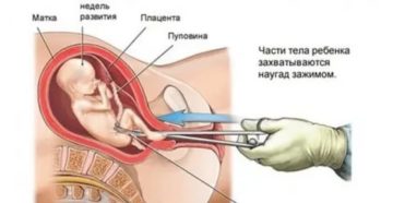 Беременность после хирургического аборта спустя 3 месяца