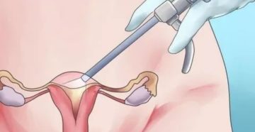 После гистероскопии ничего не назначили