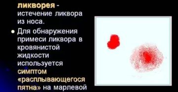 Назальная ликворея