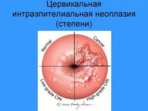 Интраэпителиальная неоплазия