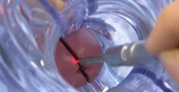 Проблемы после прижигания эрозии