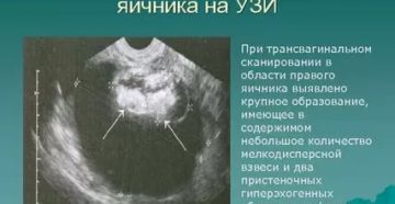Дермоидная киста, образование на яичнике, расшифровка узи