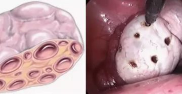 Ленивые яичники