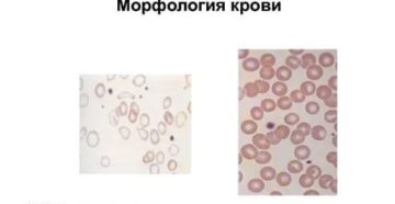 Гипохромия I. Пойкилоцитоз I у 6-ти месячного ребенка