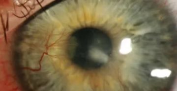 Процесс прорастания сосудов в роговицу