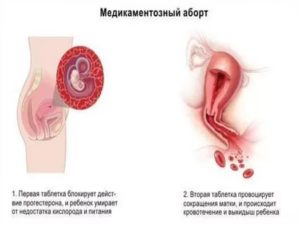 После медикаментозного прерывания беременности