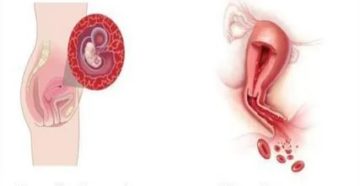 После медикаментозного прерывания беременности