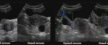 Можно ли не увидеть кисту на узи