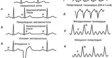 Неритмично бьется сердце экстрасистолия