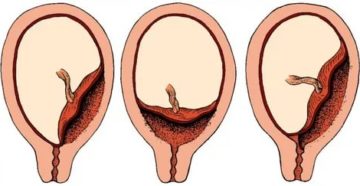 Предлежание плаценты по задней стенке