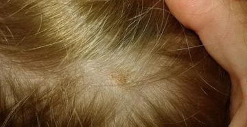 Стрептодермия в области глаза