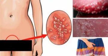 Молочница и прыщи в виде сосочков