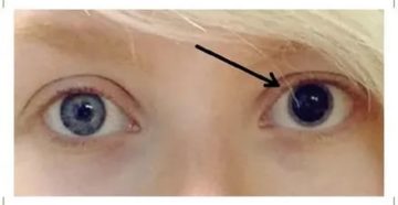 После капель один зрачок больше другого